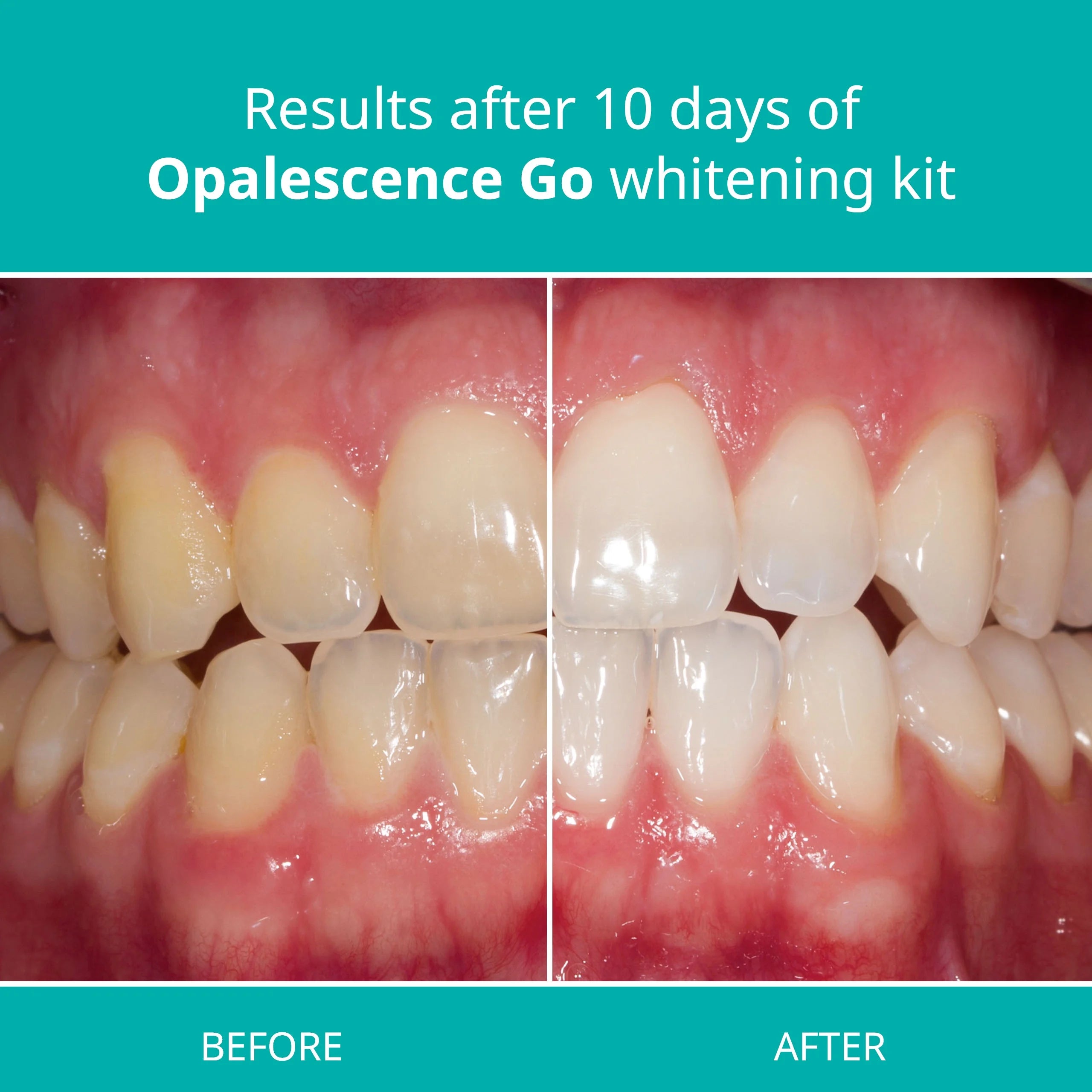 Prefilled Teeth Whitening Trays, Mint X58309